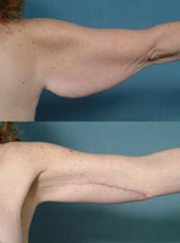 brachioplasty