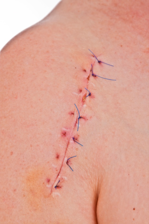 What is the average recovery time for neck surgery patients?