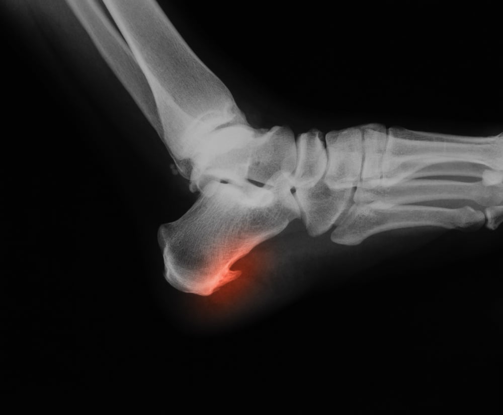 Bone spur under on sale achilles tendon surgery