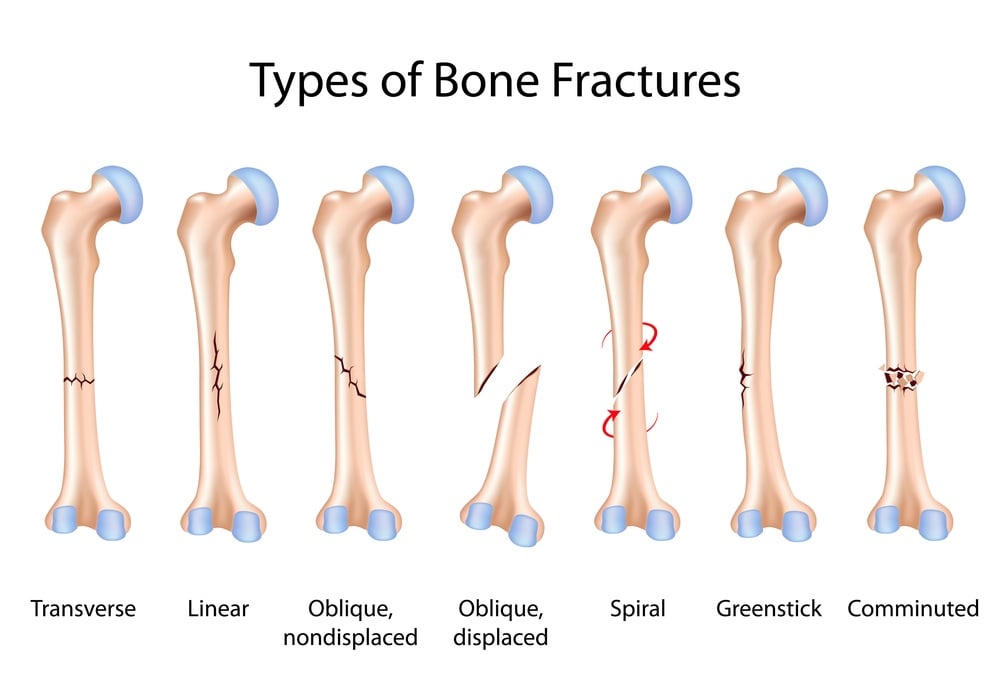 Fracture Care Treatment: When a cast not enough?