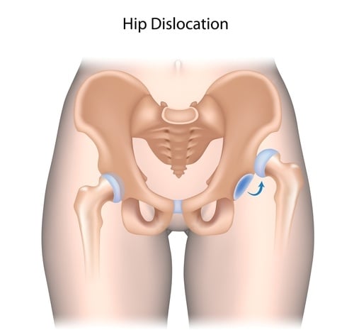 How Do I Know If My Hip Pain Is Serious? Hip Gives Out Suddenly!