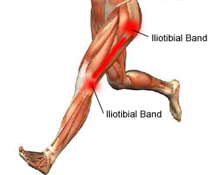 Iliotibial Band Syndrome – Kinesiology Sports Tape