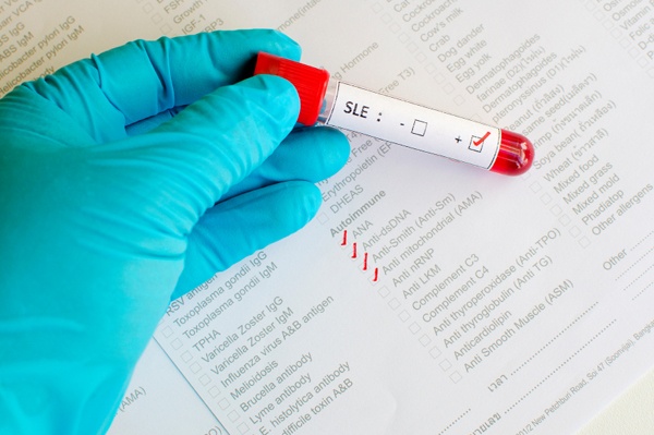 sle of research new research on systemic lupus erythematosus sle sle of research new research on systemic lupus erythematosus sle