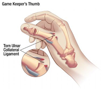 catcher's thumb treatment