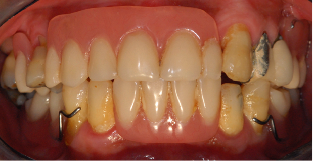 full_mouth_implants_1-1.png