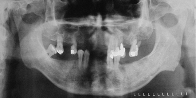 full_mouth_implants_2.png