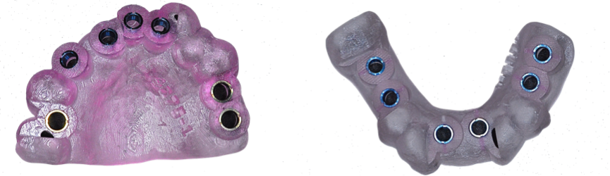 full_mouth_implants_5.png