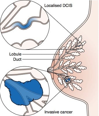 File:Diagram 1 of 2 showing stage 3B breast cancer CRUK 004.svg