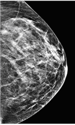 How Does The Radiologist Interpret My Mammogram?