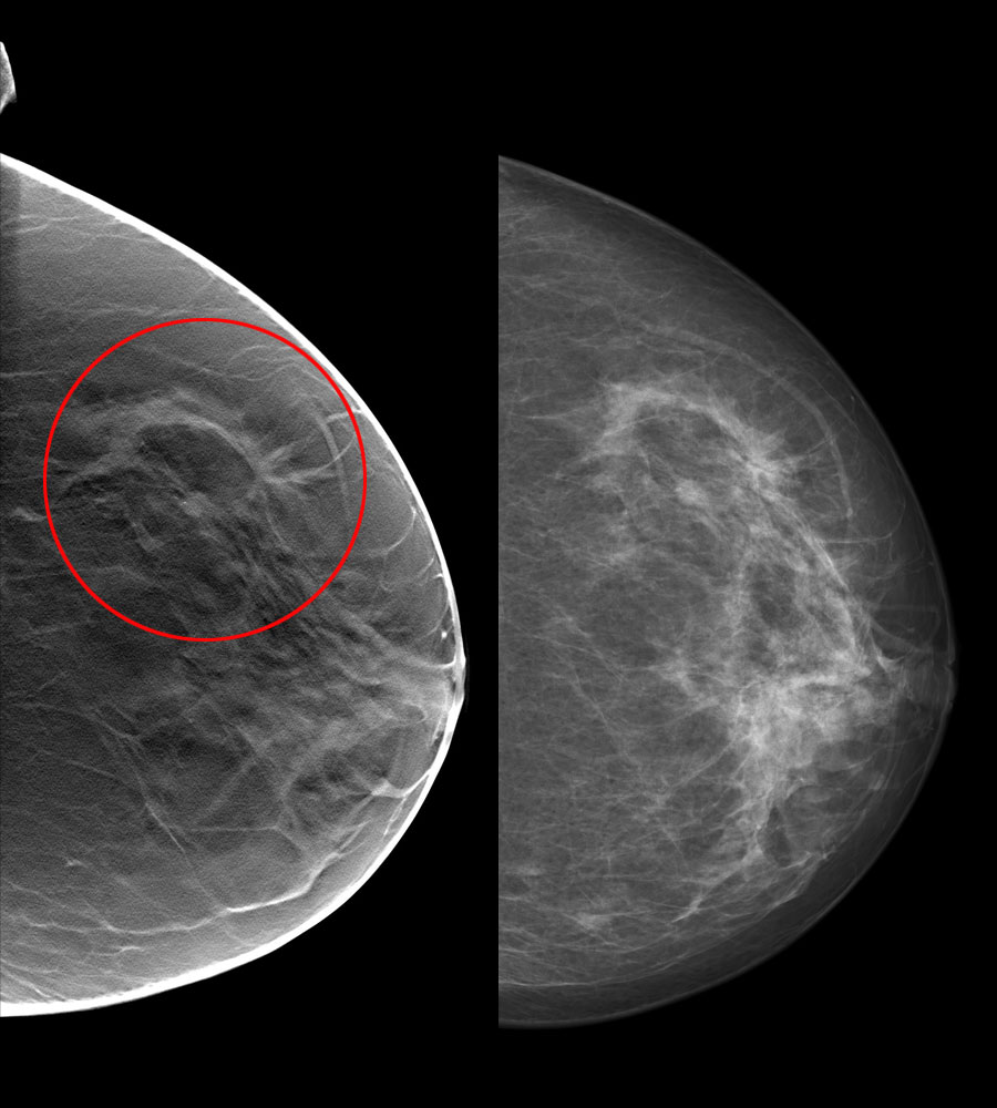 tomosynthesis mammography 3d mammography detects more cancers with fewer recalls tomosynthesis is available at women's center for radiology. tomosynthesis mammography 3d mammography detects more cancers with fewer recalls tomosynthesis is available at women's center for radiology.