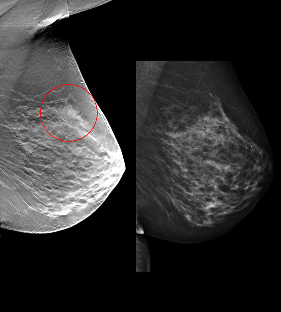 Tomosynthesis image