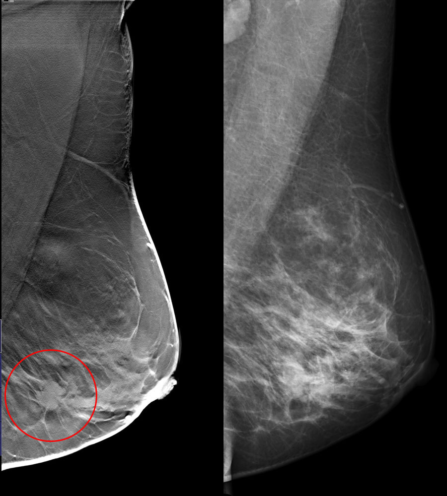 tomosynthesis reconstruction Tomosynthesis is used in 3d mammography in order to create a three dimensional image of breast tissue for better examination. tomosynthesis reconstruction Tomosynthesis is used in 3d mammography in order to create a three dimensional image of breast tissue for better examination.