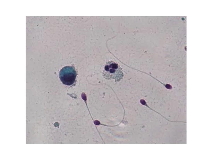 What causes sperm to be watery?