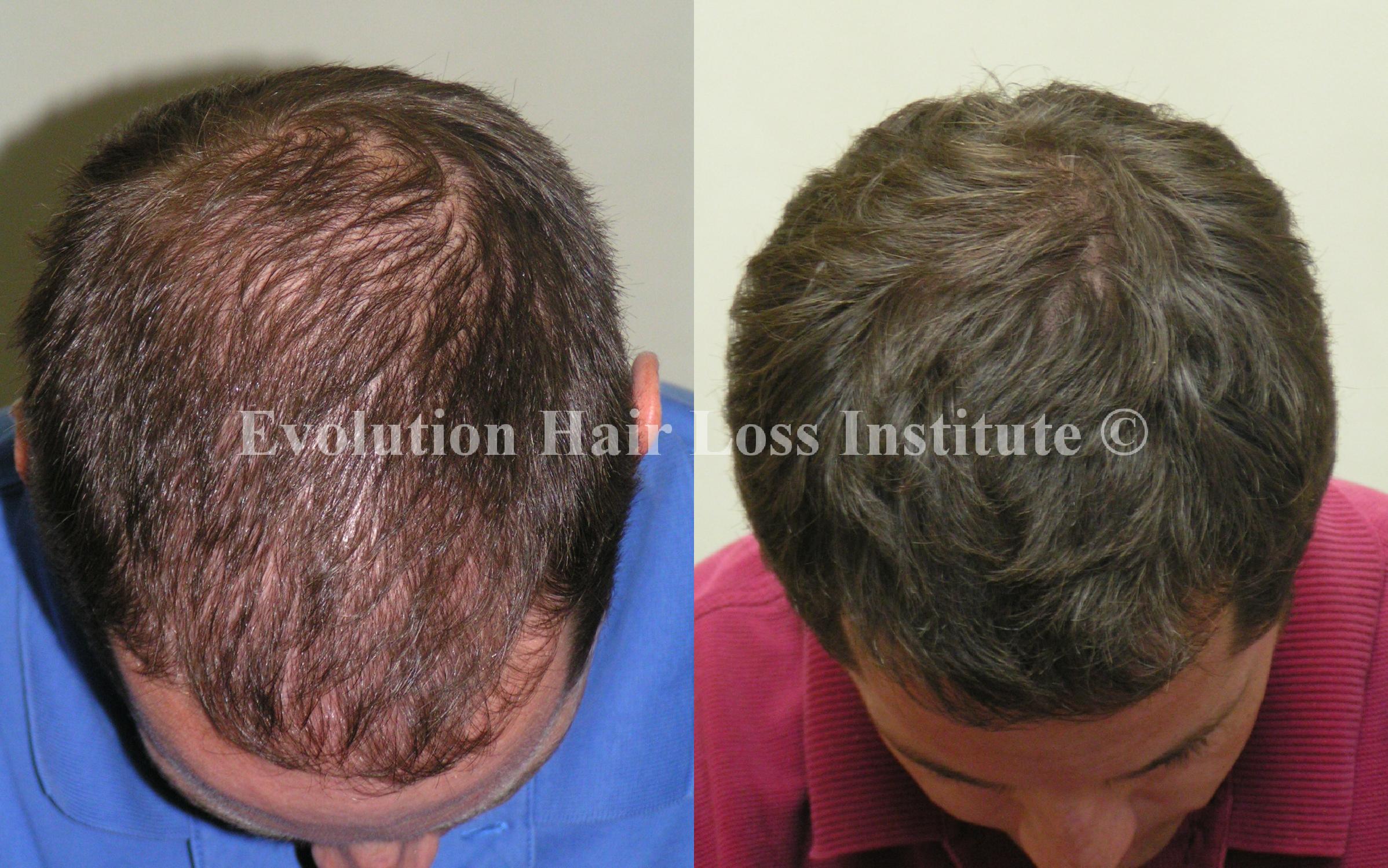 Before And After Hair Growth Treatment Photos