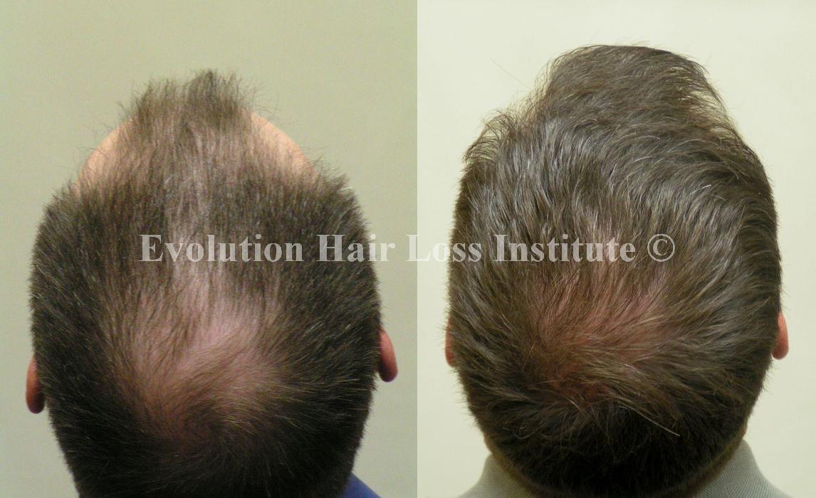 Before And After Hair Growth Treatment Photos