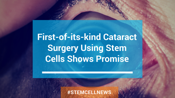 apr21-first-of-its-kind-cataract-surgery-using-stem-cells-shows-promise.png