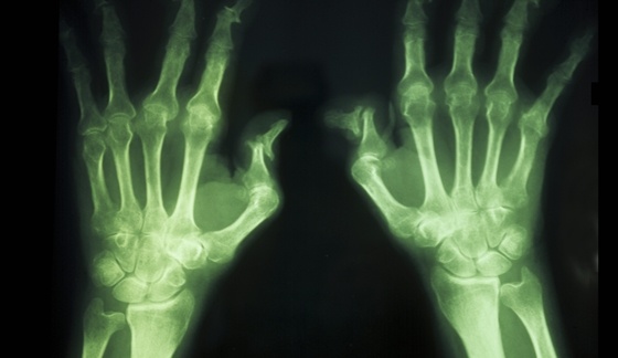 Sep_16_-_New_Stem_Cell_Treatment_Shows_Promise_for_Rheumatoid_Arthritis.jpg
