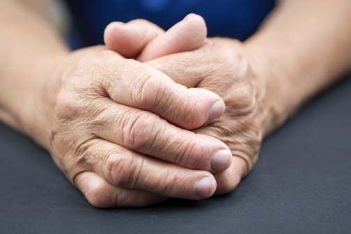 Hands_Of_Woman_Deformed_From_Rheumatoid_Arthritis