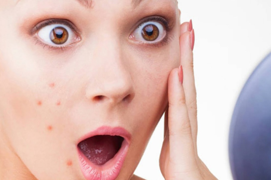 ACNE.jpg