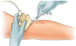 scleroterapia-ecoguidata.png