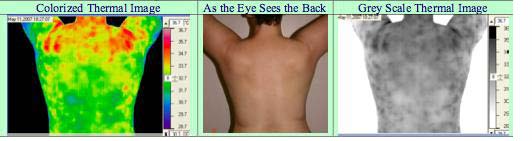 estrogen dominance symptoms