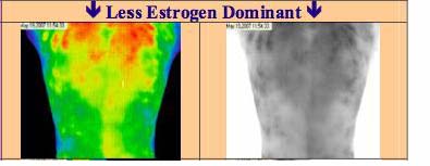 symptoms of estrogen dominance