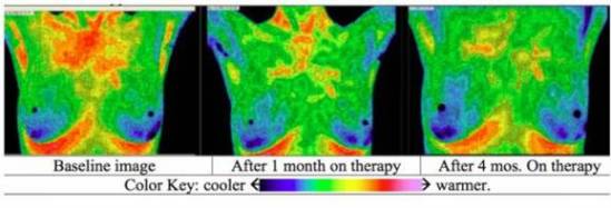 thermography_breast