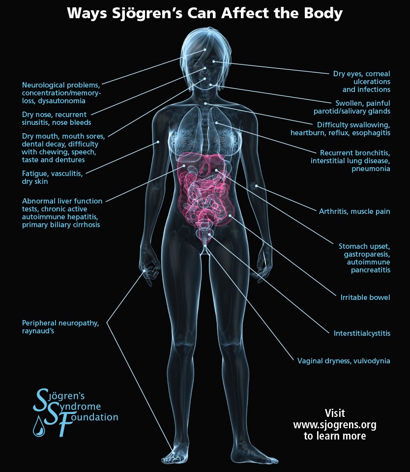 Sjogren's Body Symptoms