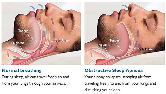 Insomnia with COPD: How to Improve Your Sleep Quality