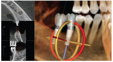 Invivo Implant Planning 