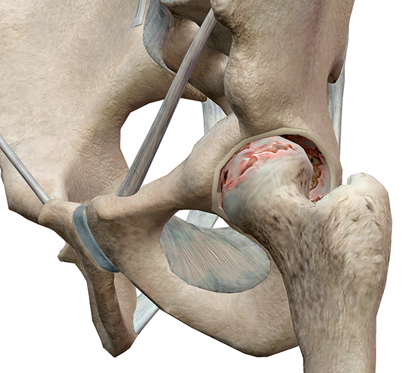 Hip-Pathology-2.png