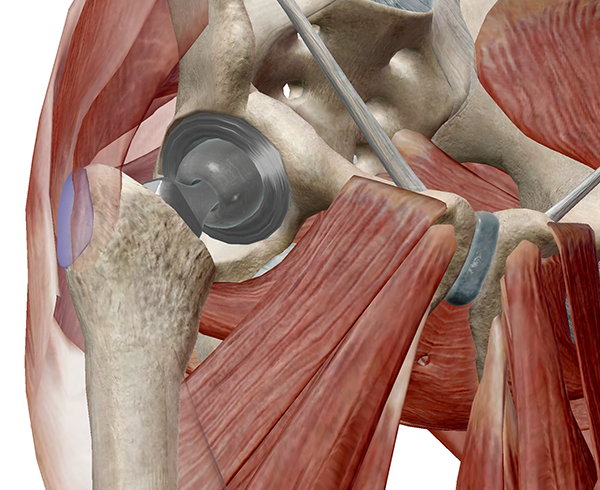 Hip-Pathology-4.png
