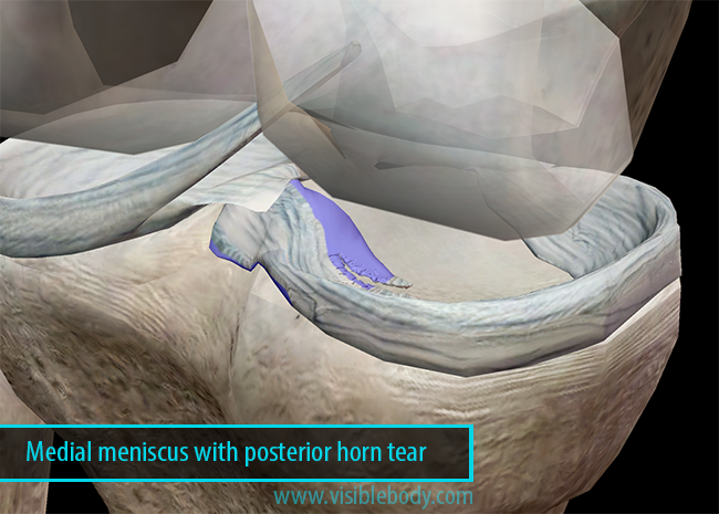 Tear Of Medial Meniscus Posterior Horn