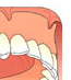 Removable Denture