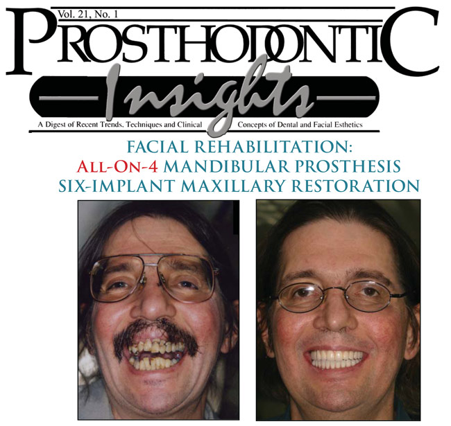 Facial Rehabilitation Using The All-On-4 Mandibular Prosthesis