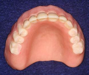 Removable denture