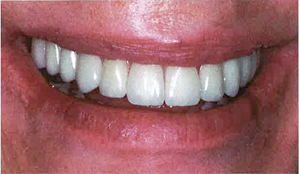 A healthy smile is achieved using the No Bone Solution Dental Implant Protocol
