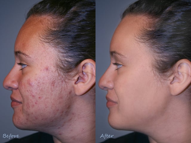 feature-vs-benefit-acne-example.jpg feature vs benefit acne example