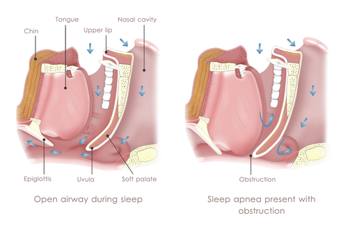 obstructive-sleep-apnea.jpg