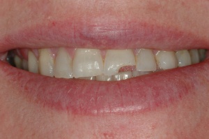 A 56- year-old female presented with a fracture on central incisor tooth #9 sure to trauma.