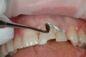 A retraction cord (GingiBRAID+ #2, Dux Dental, Oxnard, CA) was placed to isolate tooth #9 prior to treatment.