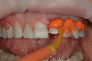 FIGURE 4: The Virtual® XD light body fast set wash material was syringed around the preparation, with the tip buried into the material to avoid air, bubbles, or kids in the impression.