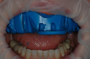 The Virtual® XD heavy body fast set tray material was dispensed into the tray and seated in the patient's mouth for 2 ½ minutes.