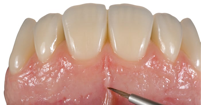 Pink esthetics: How to create natural-looking gingiva with laboratory composite?
