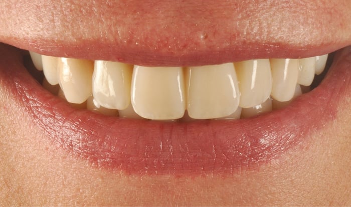 Guided concept in the esthetic zone