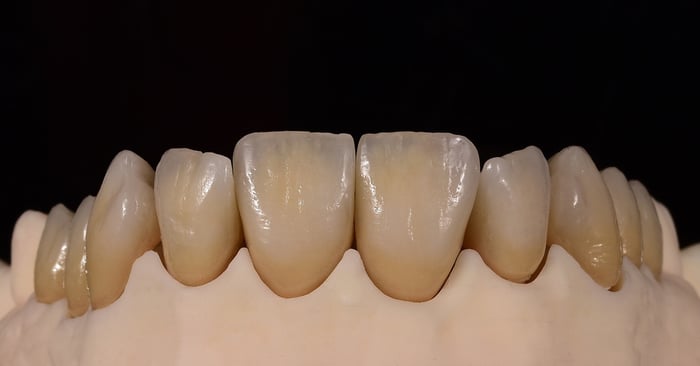 La competición de las cerámicas: ¿qué cerámica tiene más éxito, IPS Style o IPS d.SIGN?