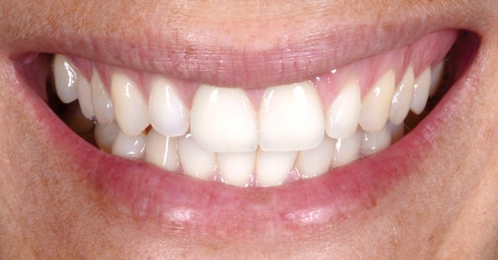 Système d’éclaircissement dentaire sans gouttière : par ex. pour éclaircir les dents adjacentes aux facettes