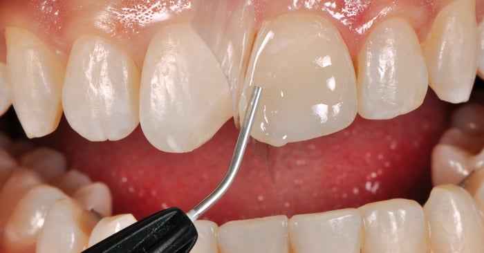 Consiglio pratico: ecco come avere una visione d'insieme dei compositi Bulk Fill