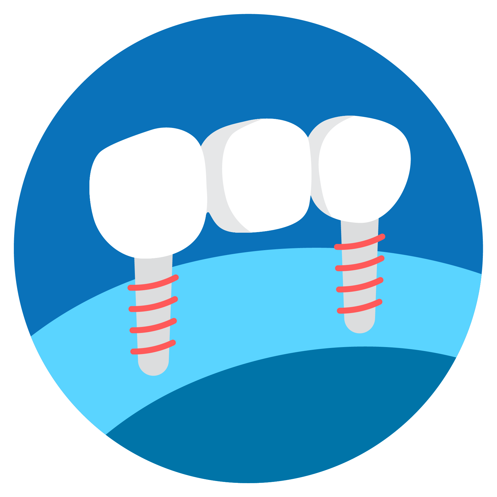 Fixed Prosthetic Track