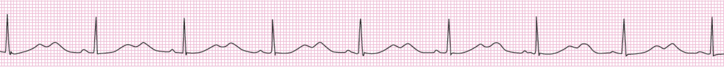 12Lead ECG and Patients with Syncopal Episodes (Case 3)